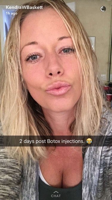 Kendra Wilkinson Snapchats Her First Botox Procedure Im Finally 7371