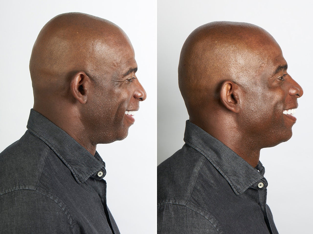 Deion Sanders gets botox