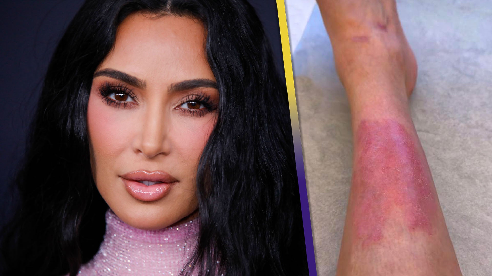Kim Kardashian Shared Videos of Her 'Painful' Psoriasis Flare-Up