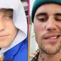 Justin Bieber Shares Progress After Ramsay Hunt Diagnosis