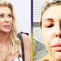 Brandi Glanville Reveals Facial Disfigurement Amid 'RHUGT' Controversy