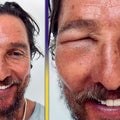 Matthew McConaughey's Eye Is Swollen Shut After Bee Sting