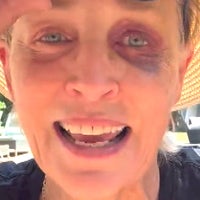 Sharon Stone Explains How She Got a Massive Black Eye