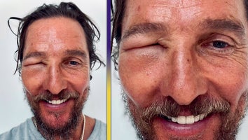 Matthew McConaughey Shows Off Wild Bee Sting Swelling