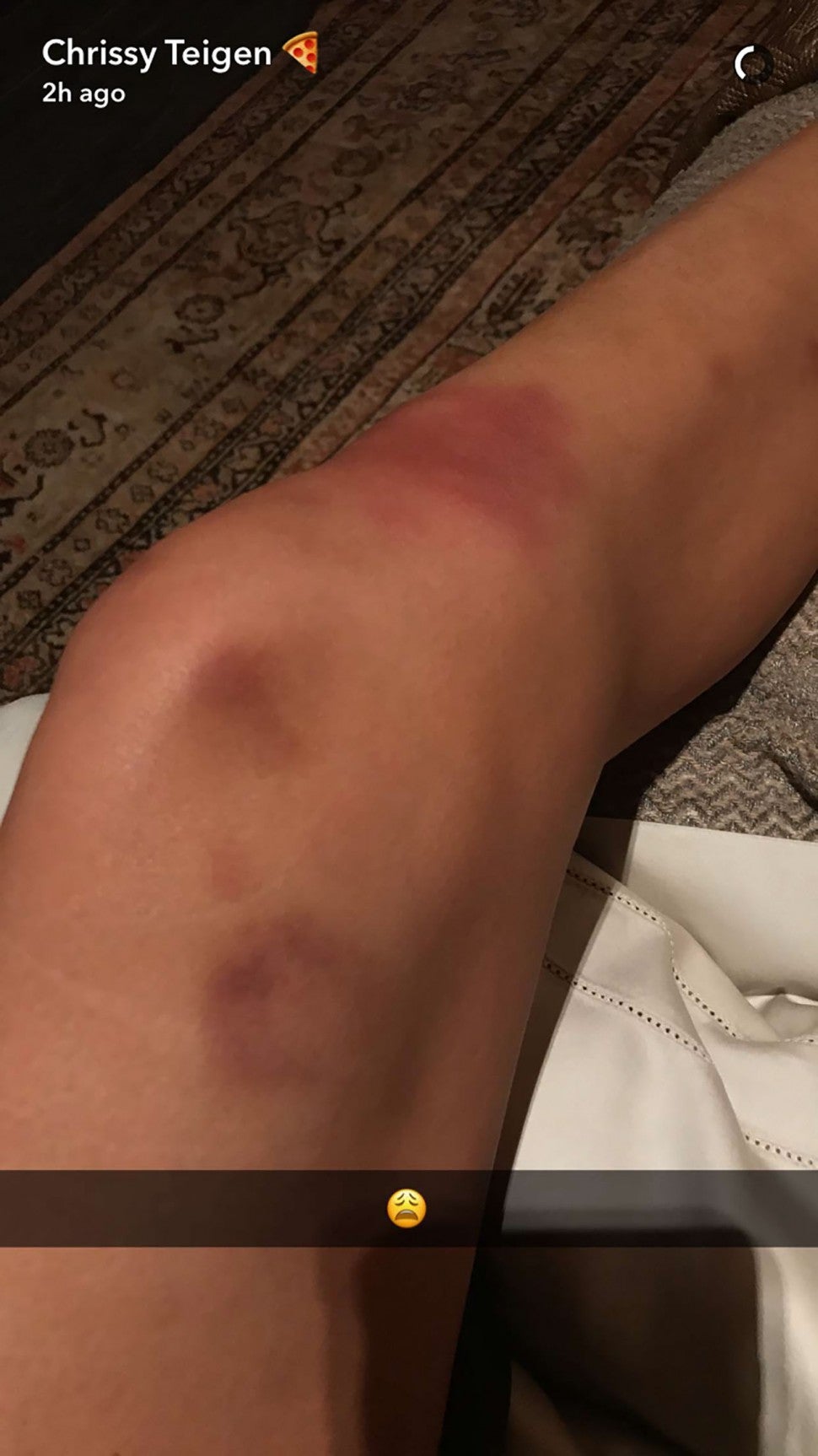 shin bruises