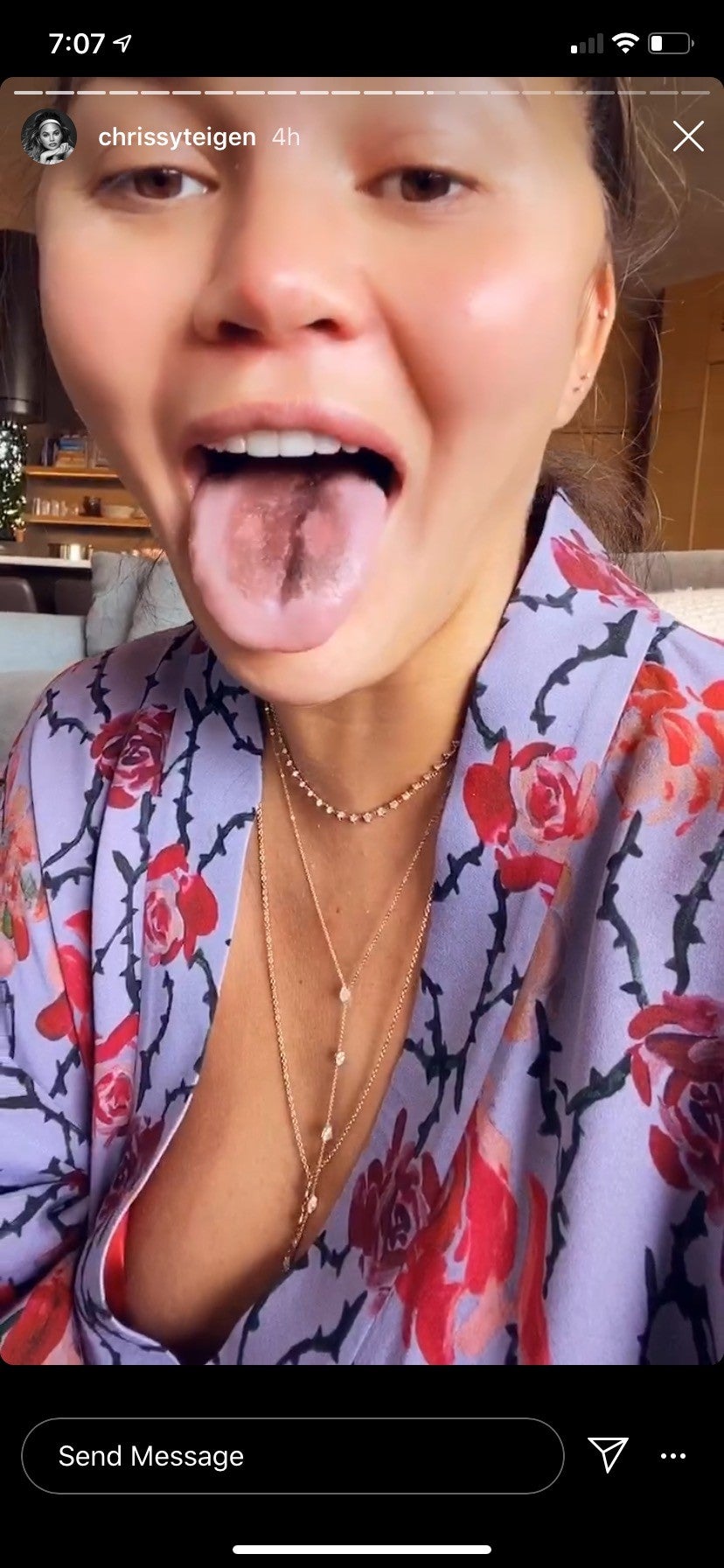 Chrissy Teigen Says Her Tongue Is Falling Off From 