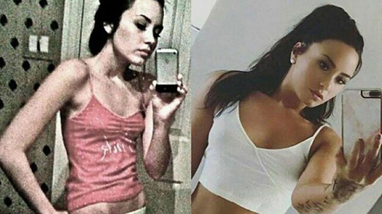 demi-lovato-shares-shocking-before-and-after-pictures-of-her-ongoing-battle-with-an-eating