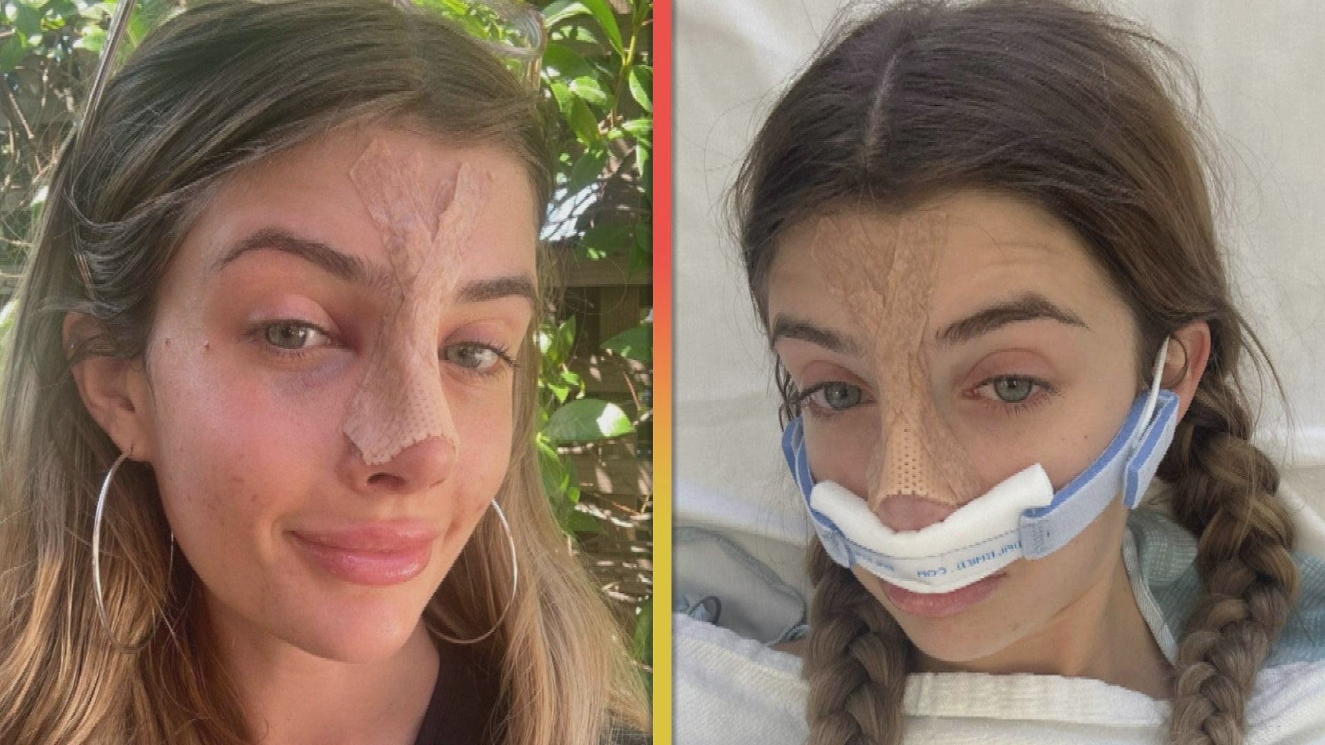 Sami Sheen Documents Her Painful Nose Job Surgery