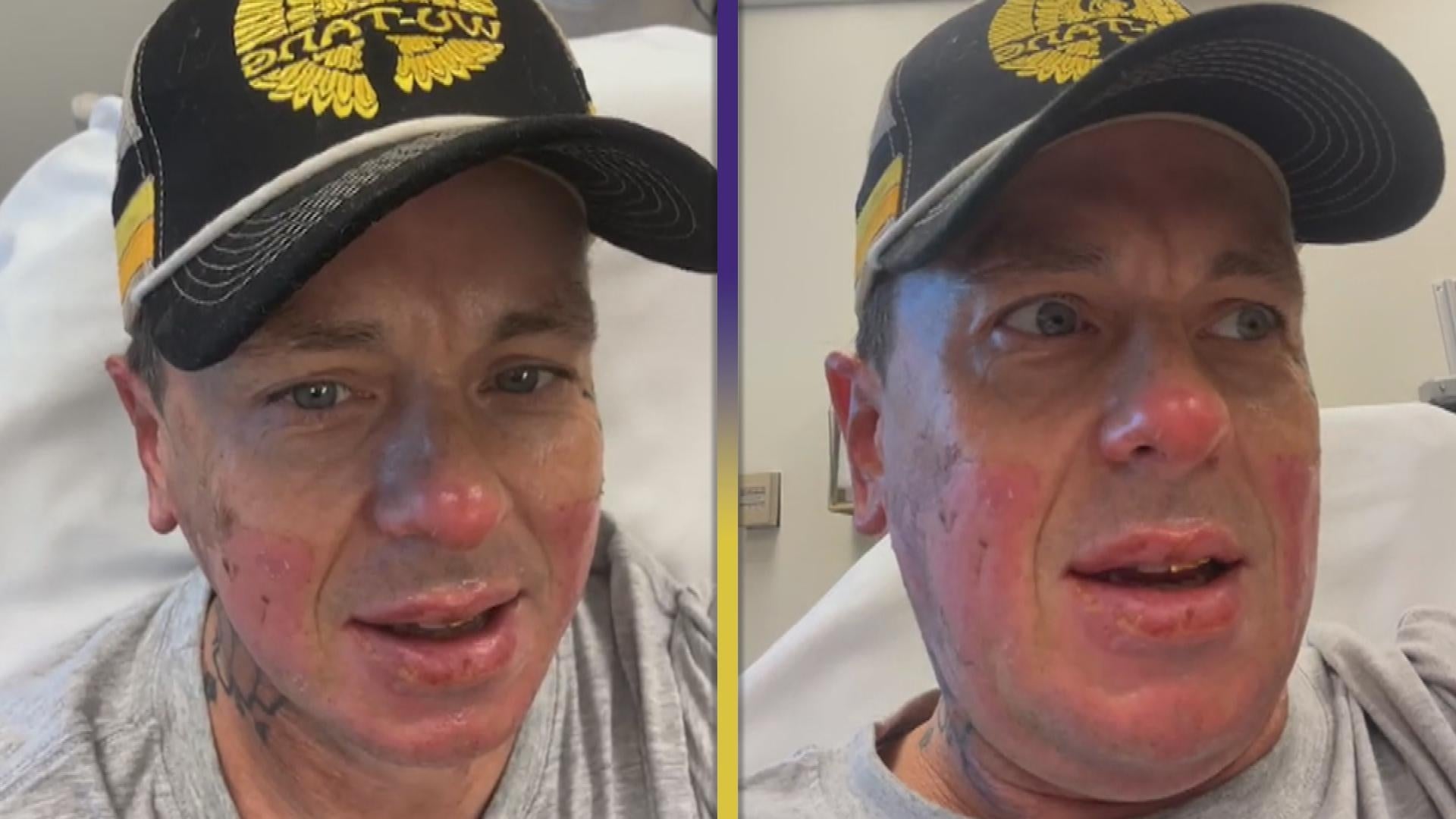 Slipknot's Sid Wilson Reveals His Face Is 'Melted' From Nose Down After Bonfire Accident