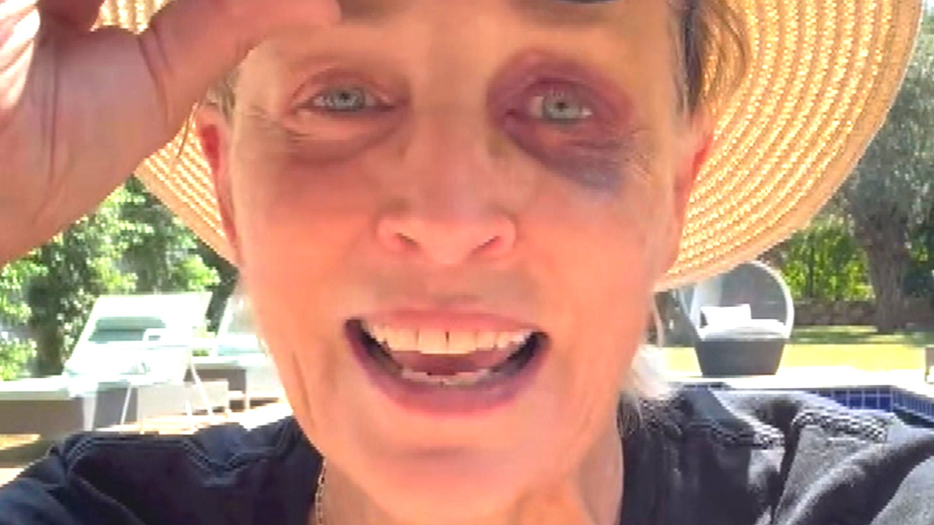 Sharon Stone Explains How She Got a Massive Black Eye